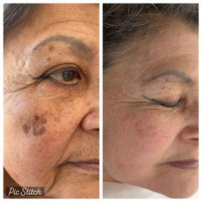 Age Spot Removal