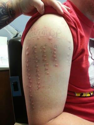 Allergy testing