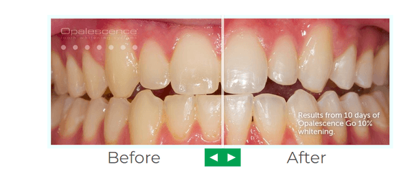 Teeth Whitening 
Opalescence