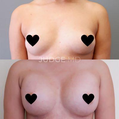 Breast Augmentation