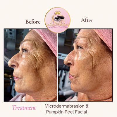 Microdermabrasion & Pumpkin Peel Facial