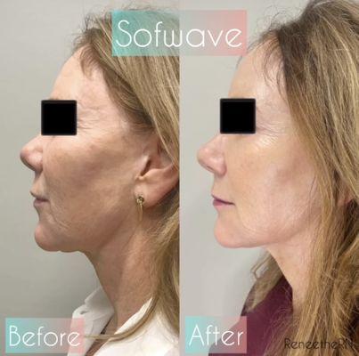 Sofwave: non surgical lift with results as early as 1 month