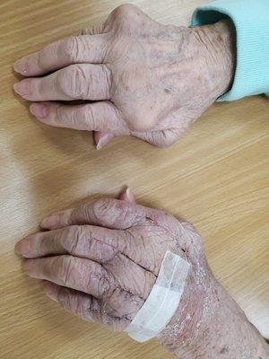 Rheumatoid Arthritis Joint replacements :  Hand Therapy is a MUST!