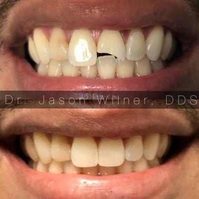 A beautiful result for a young man who fractured his tooth in only a single visit done by Dr. Jason Wilner