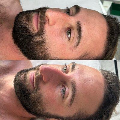 Before and after the MiraPeel facial