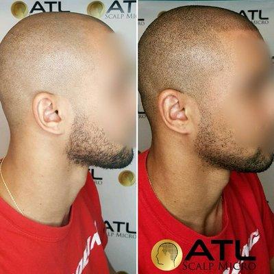 Before and After Scalp Micropigmentation on Black Male at ATL Scalp Micro Atlanta GA