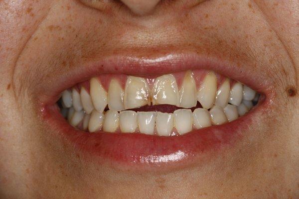 Veneers Before