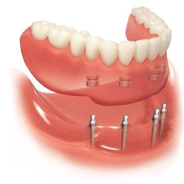 Mini Dental Implant Supported Denture