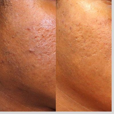 Microneedling with SkinPen - 3 Sessions