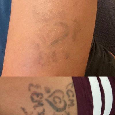 Top = Results after 4 sessions Bottom= Original tattoo