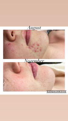 Three months results... with the right facials, products and commitment you could have the skin of your dreams.