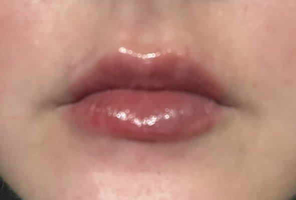 Lips right after the hyaluronic pen filler