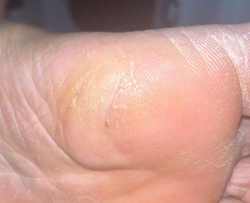 Callus Removal