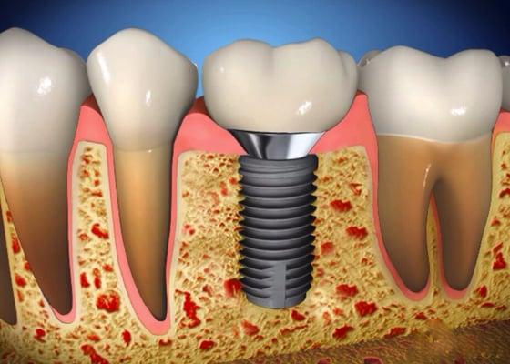 Call us today for a dental implant consultation!