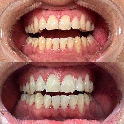 Before & After a 60 mins teeth whitening procedure