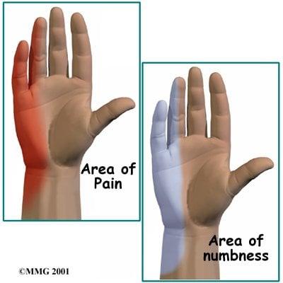 cubital tunnel syndrome