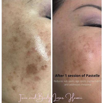 Pastelle (reduce sunspots, Melasma, age spots)