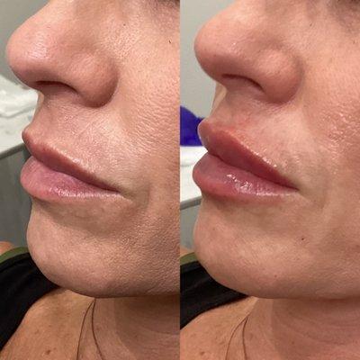 BEFORE+AFTER: 1 syringe of Restylane Kysse! Injections by our amazing RN Sarah!