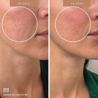 Gorgeous results from acne scar treatments with Dr. Andrea Hui Austin.