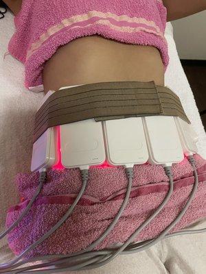 Laser lipolysis.