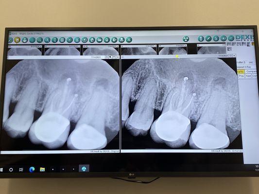 One root canal down. Another to go!