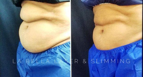 CoolSculpting at its finest! This result was just 5 weeks after this client's first treatment using 3 contours.