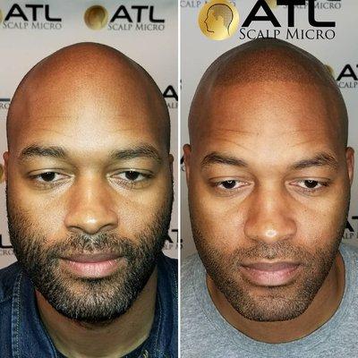 Scalp Micropigmentation Hair Replication Tattoo at ATL Scalp Micro Atlanta