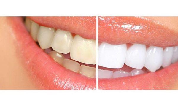 Before and after teeth whitening!!!