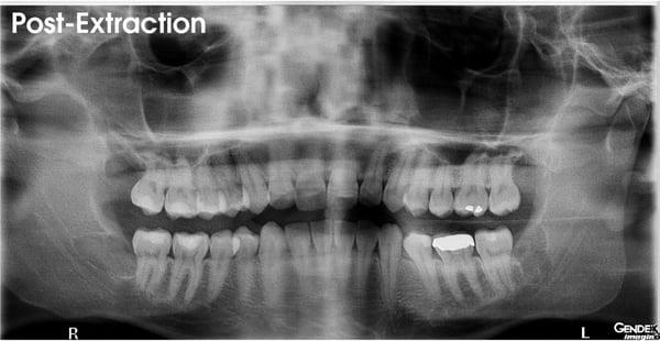 Panoramic x-ray post wisdom teeth extraction. All teeth out - no nerve damage done!