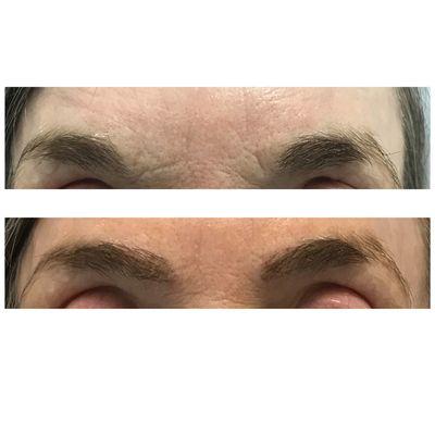 Reshaped the eyebrows by adding grafts to the central portion.