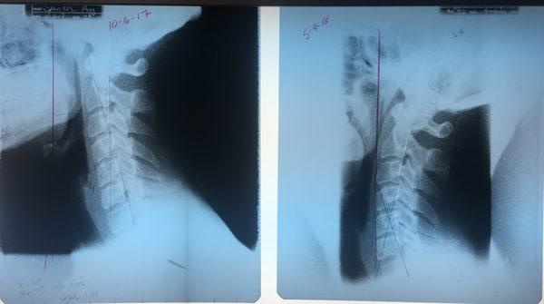 Results from working with Dr. Travis over 6 months time. Back pain almost non-existent nowadays. She knows her stuff.