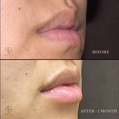 Lip Filler performed by Dr. Kang