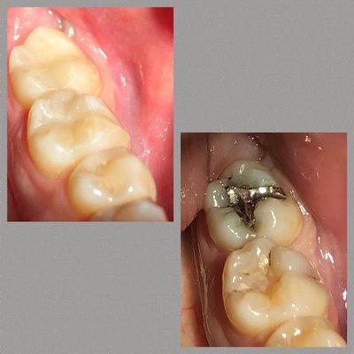 Transformation from Silver Fillings to Tooth Colored.