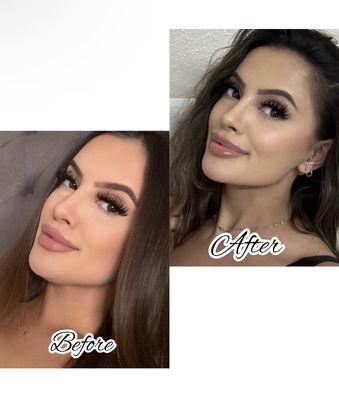 Mesotherapy before and after