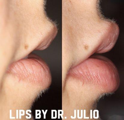 Botox lip flip is a great alternative to fillers.