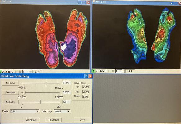 Neuropathy Live Infra Red Scan