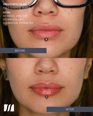 Our beautiful patient wanted something very subtle and natural. We used a half syringe of lip filler to achieve these results!