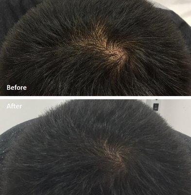 PRP Hair Restoration- 1 Session