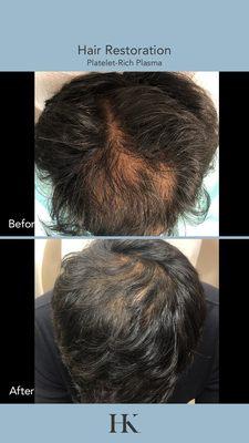 Click to see more of Dr. Khorasani's before and after photos:
https://www.drkhorasani.com/before-and-after-gallery/hair-restoration