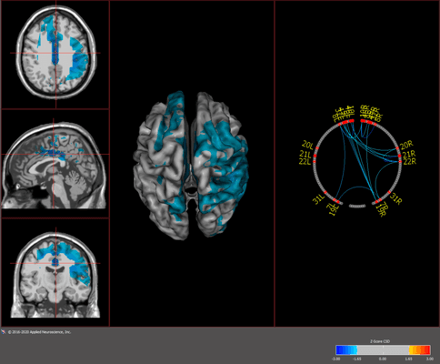 The next generation in neurofeedback training for attention, memory, anxiety, and sports concussions