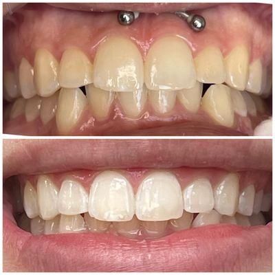 Teeth Whitening-1st session , 40min