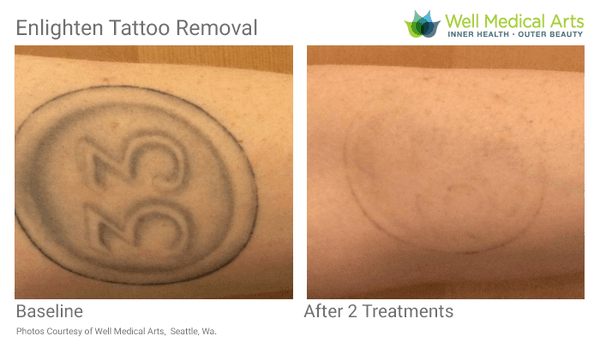 Learn more at http://www.wellmedicalarts.com/tattoo-removal/