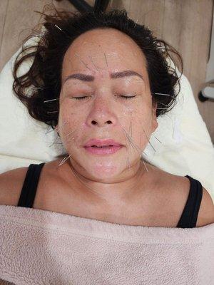 Facial acupuncture treatment