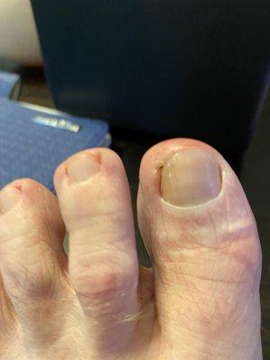 Big toe on left foot.