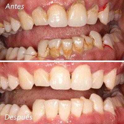 Vista Oasis Smiles - antes y despues de limpieza dental