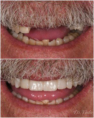 Smile Makeover with implant retained bridge