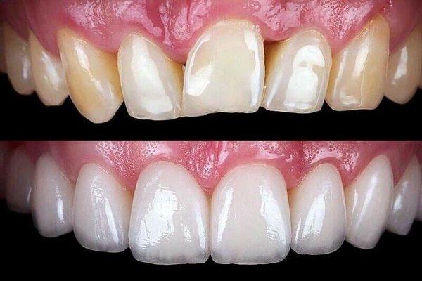 Before after Crystalline Porcelain Crowns