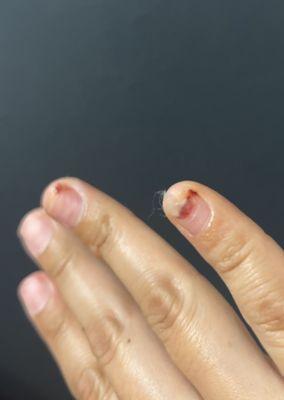 2 other nails they left bleeding.