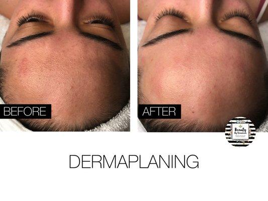 Before & After dermaplaning treatment