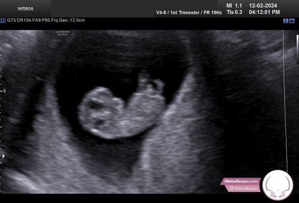 Little Bellies 9Week Ultrasound